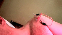 Korean Acupuncture thumbnail